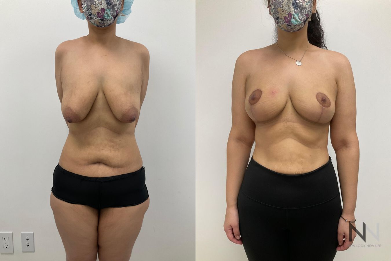 Before-and-after comparison showing improved breast balance, contour, and nipple position following right breast reduction and left breast mastopexy.