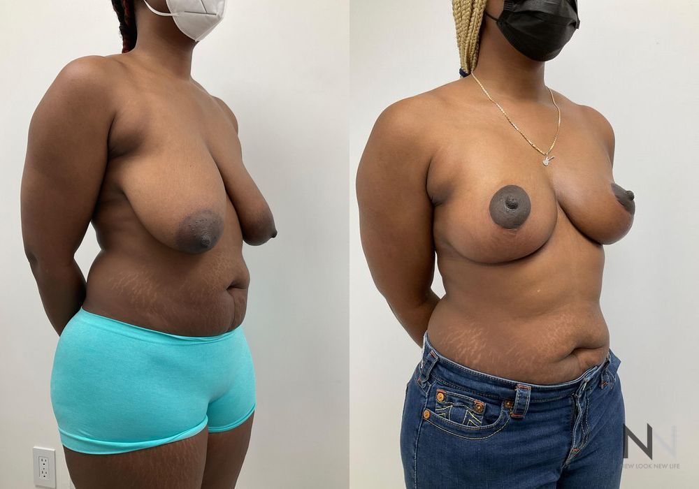 Breast Reduction - Thumbnail 2