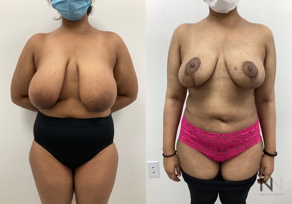 Breast Reduction - Case 1856