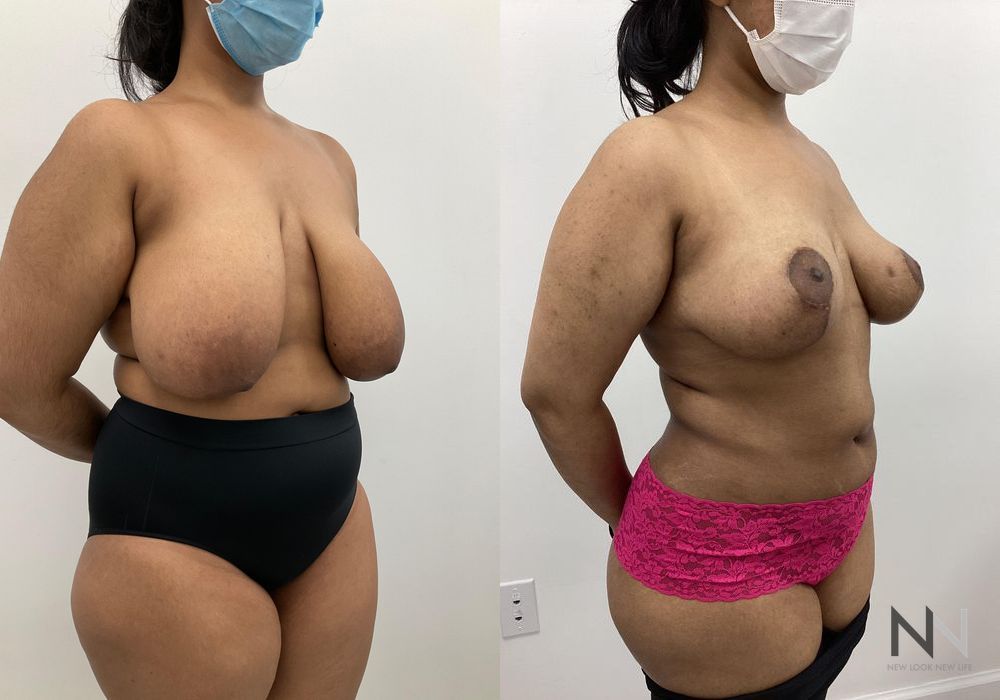 Breast Reduction - Thumbnail 2