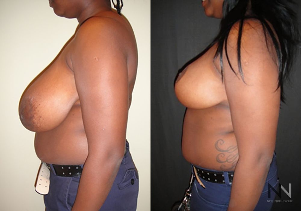 Breast Reduction - Case 1861