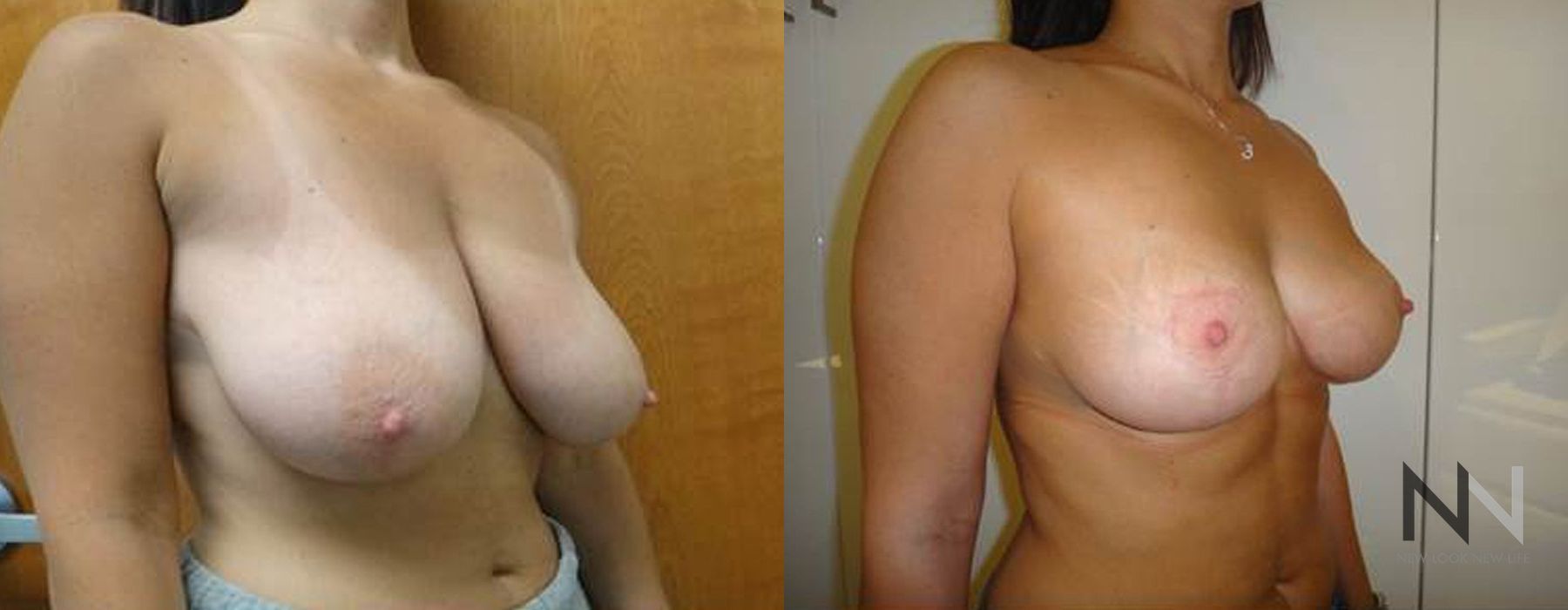 Breast Reduction - Thumbnail 2