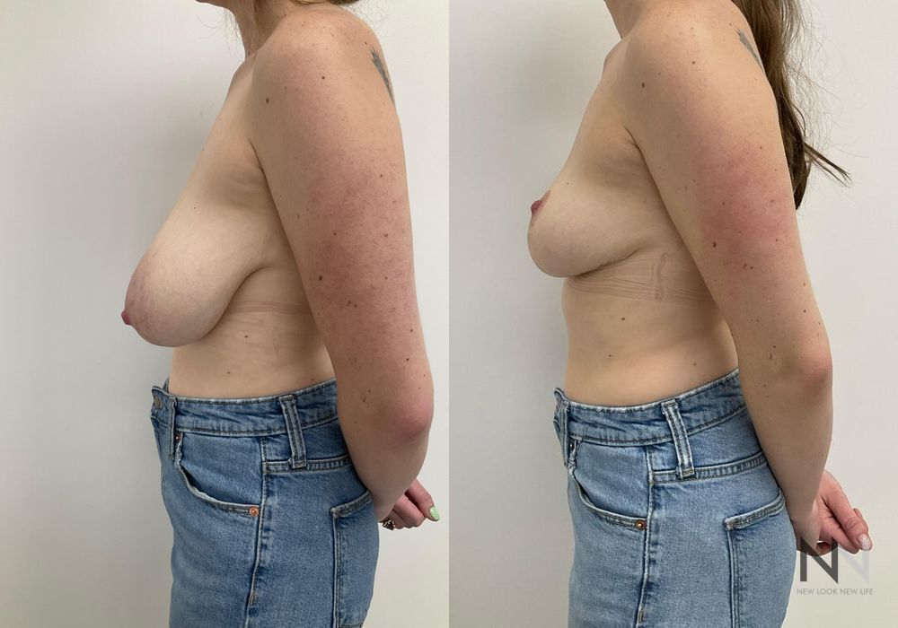 Before and after Breast Reduction case 21003 - Angle 5
