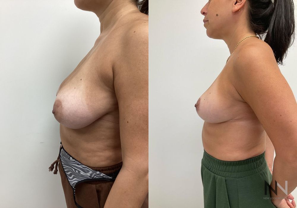 Breast Reduction - Case 1858