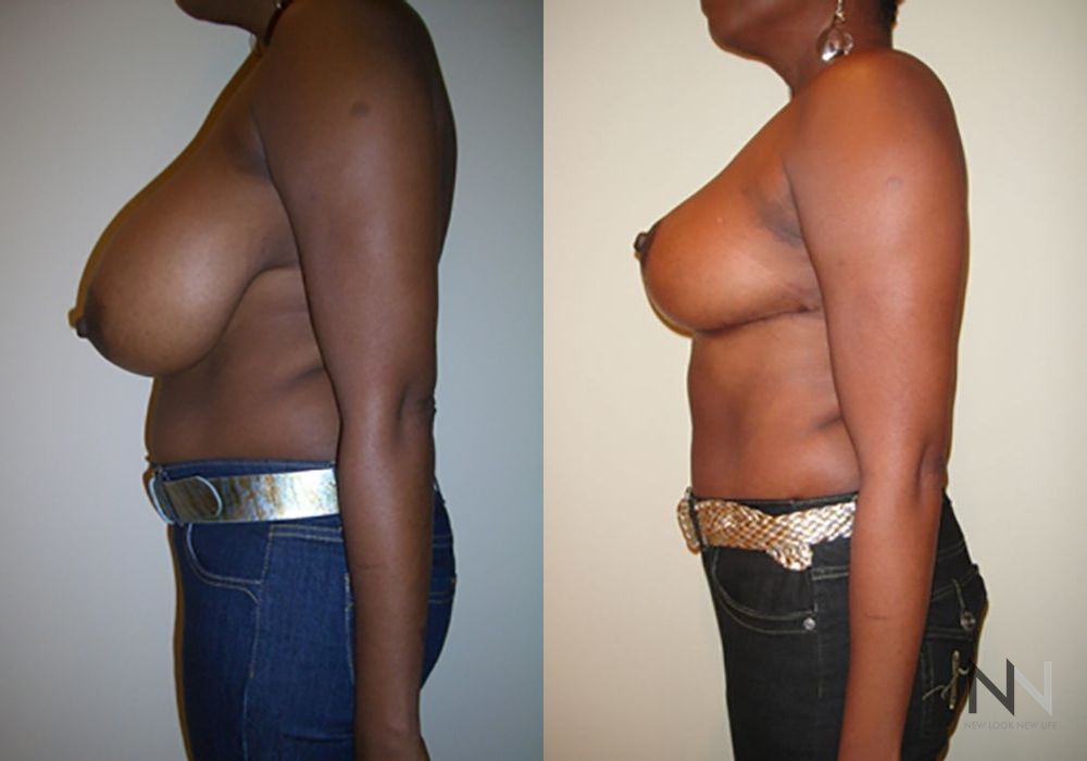 Breast Reduction - Thumbnail 3