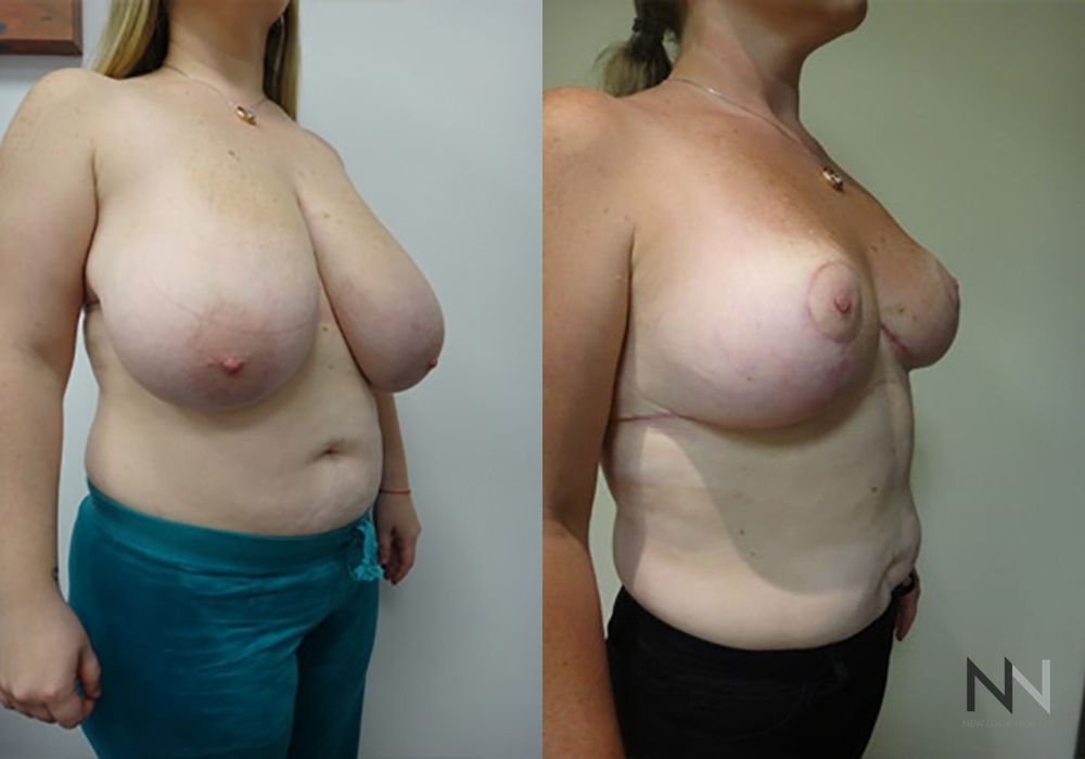 Breast Reduction - Thumbnail 2