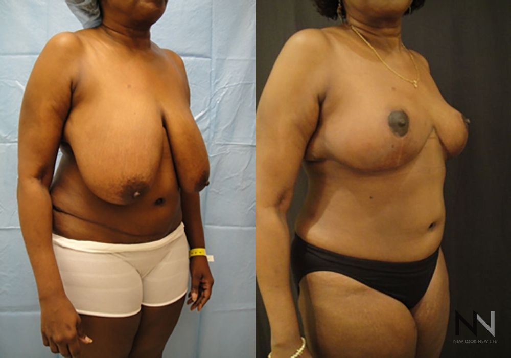 Breast Reduction - Thumbnail 3