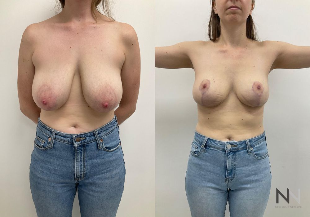 Breast Reduction - Case 1866
