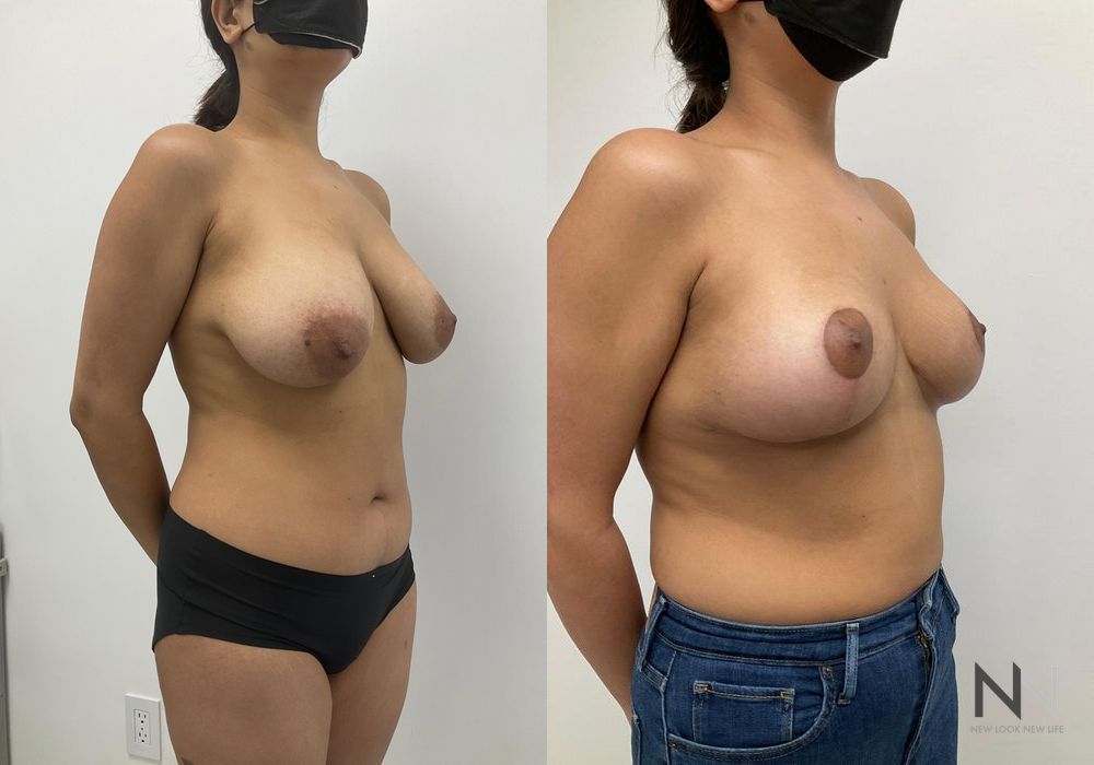 Breast Reduction - Thumbnail 3