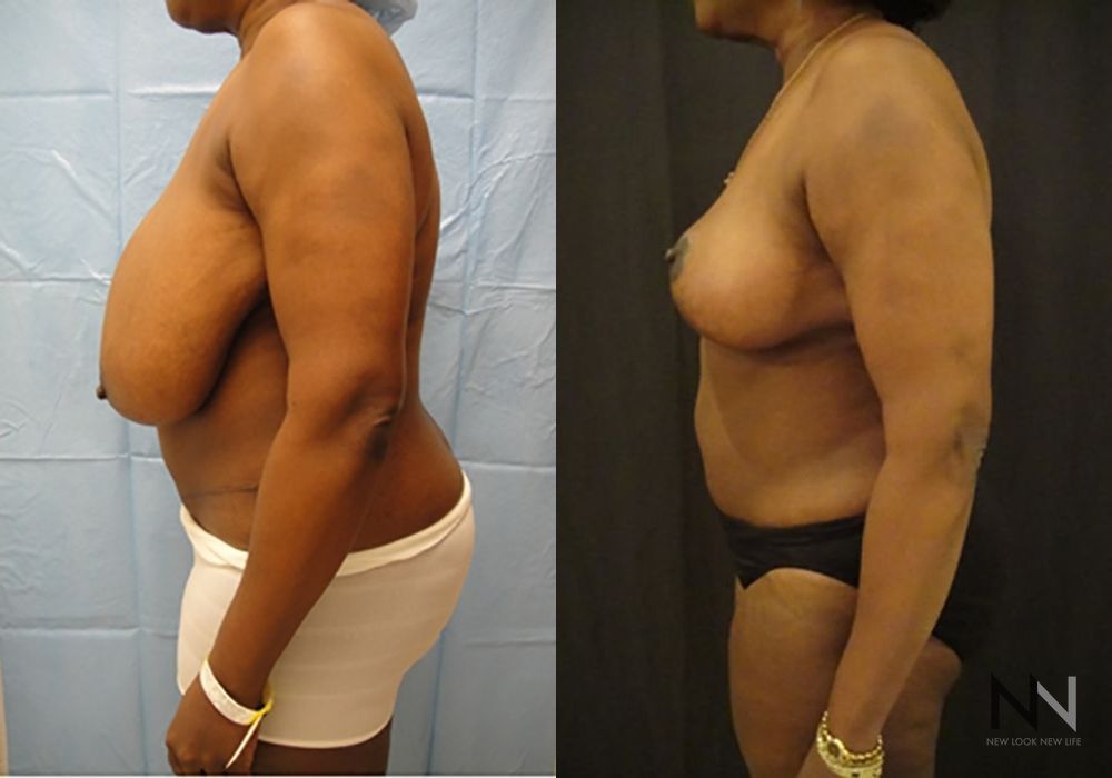 Breast Reduction - Thumbnail 4