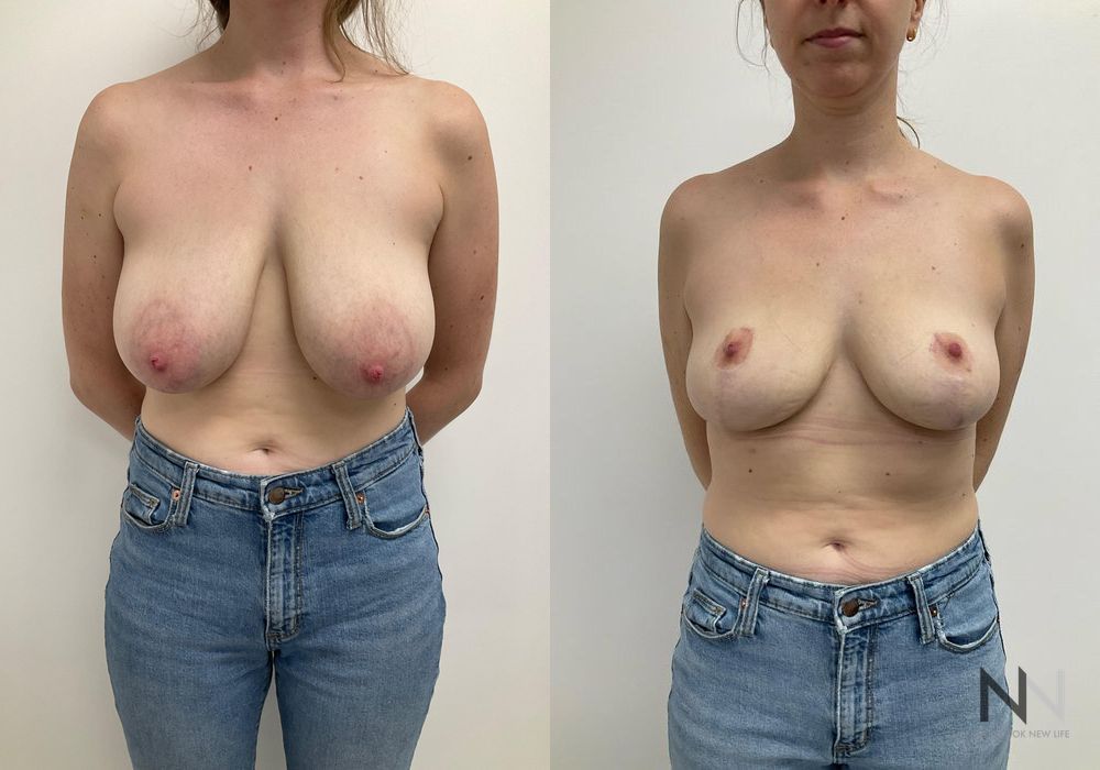 Breast Reduction - Case 1850