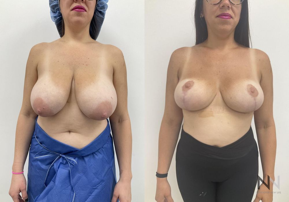 Breast Reduction - Case 1868