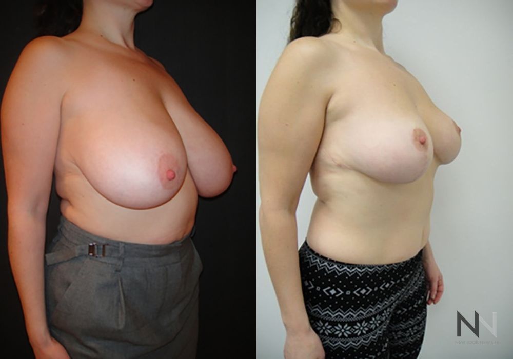 Breast Reduction - Thumbnail 4