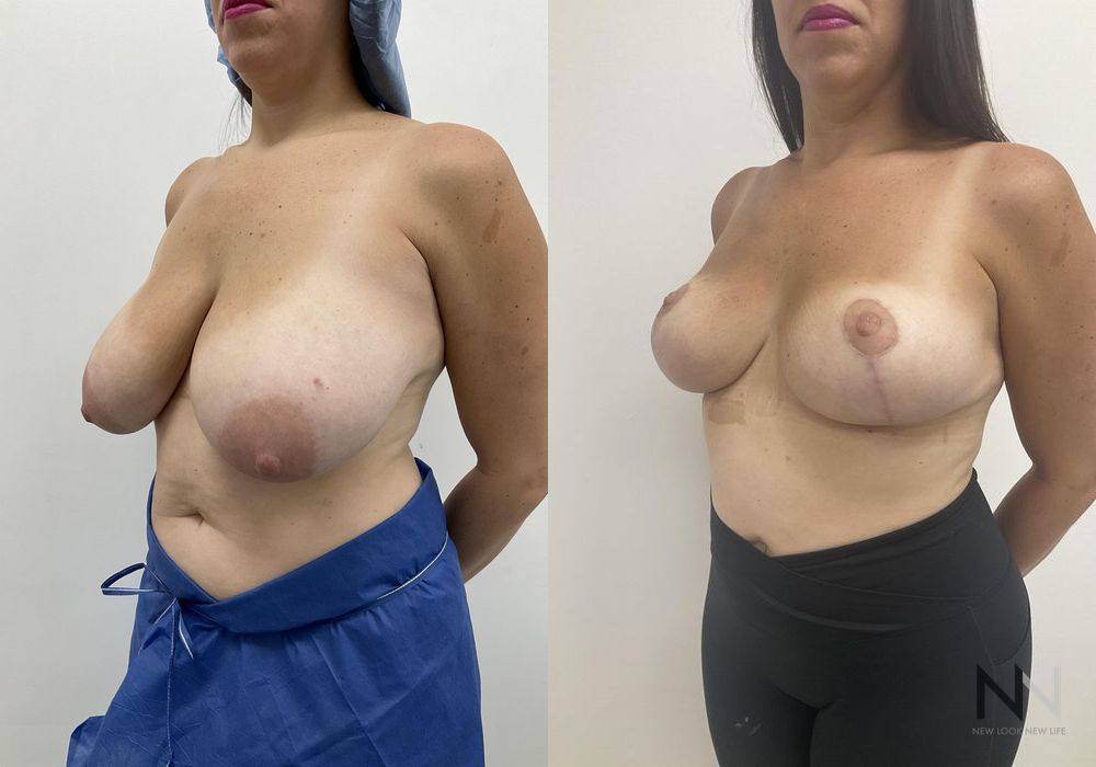 Breast Reduction - Thumbnail 3