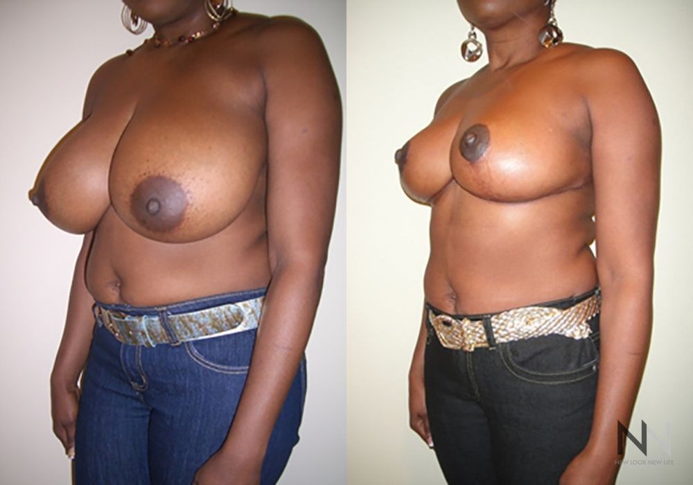 Breast Reduction - Thumbnail 2