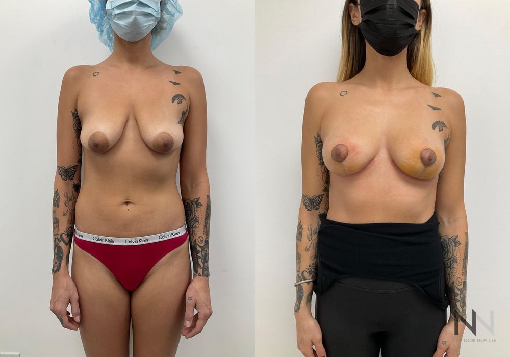 Breast Reduction - Case 1852