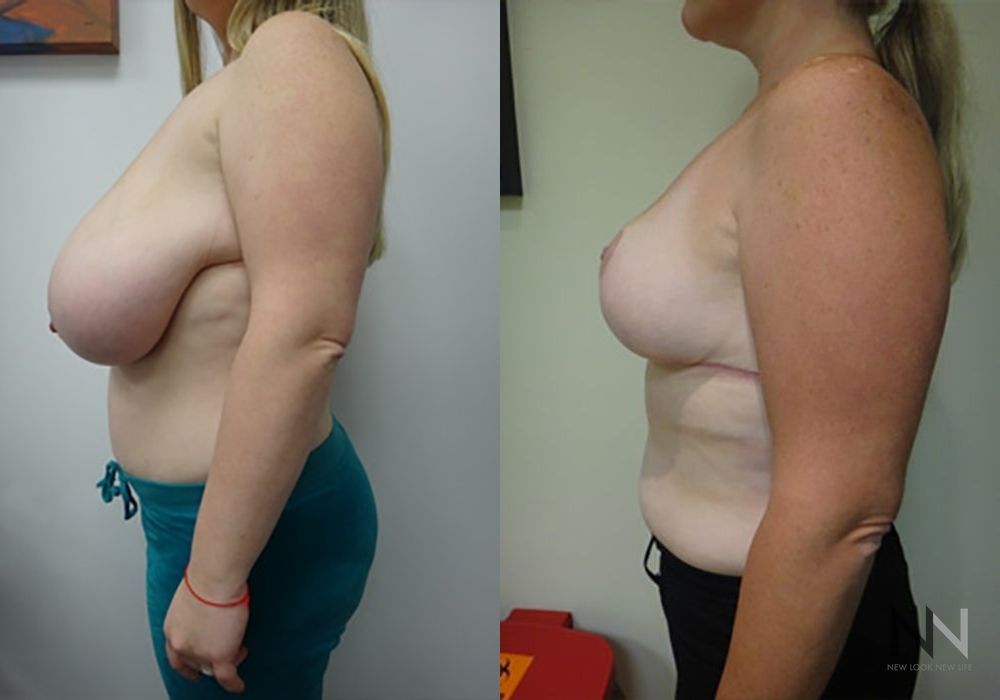 Breast Reduction - Thumbnail 3