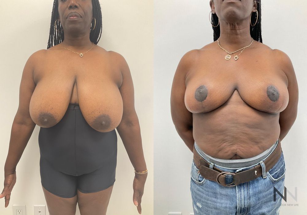 Breast Reduction - Thumbnail 2