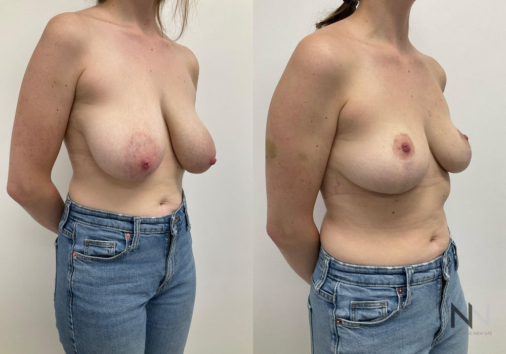 Before and after Breast Reduction case 21003 - Angle 4