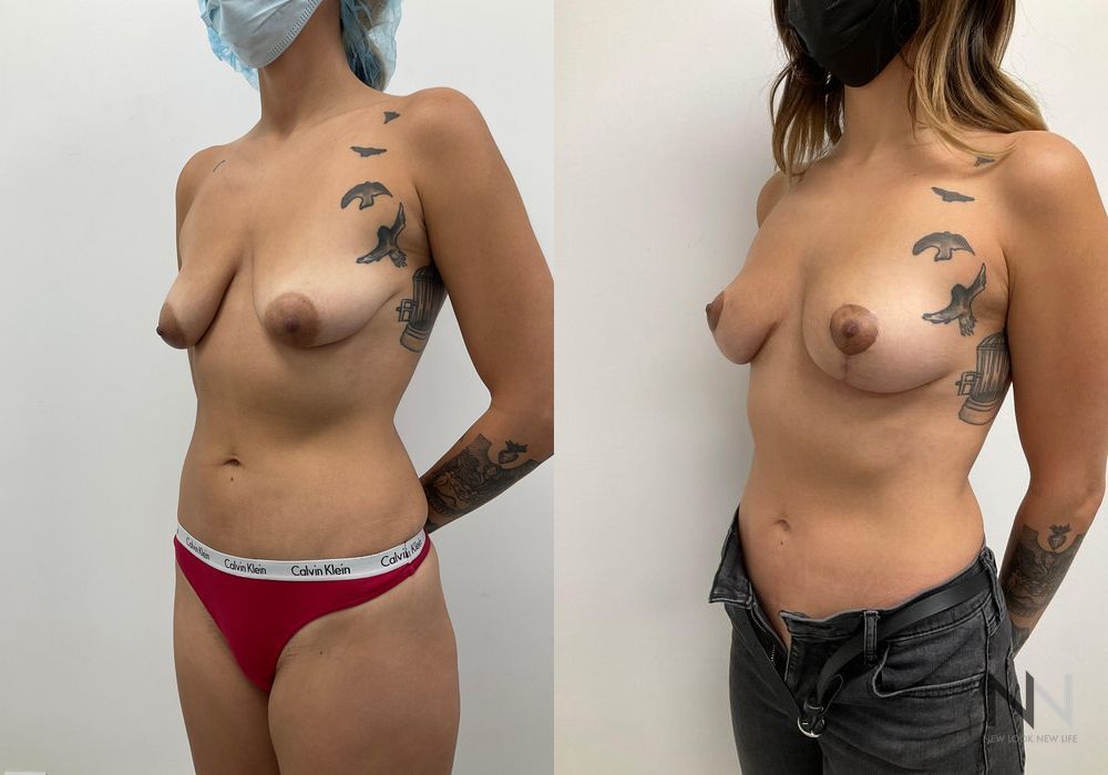 Breast Reduction - Thumbnail 3