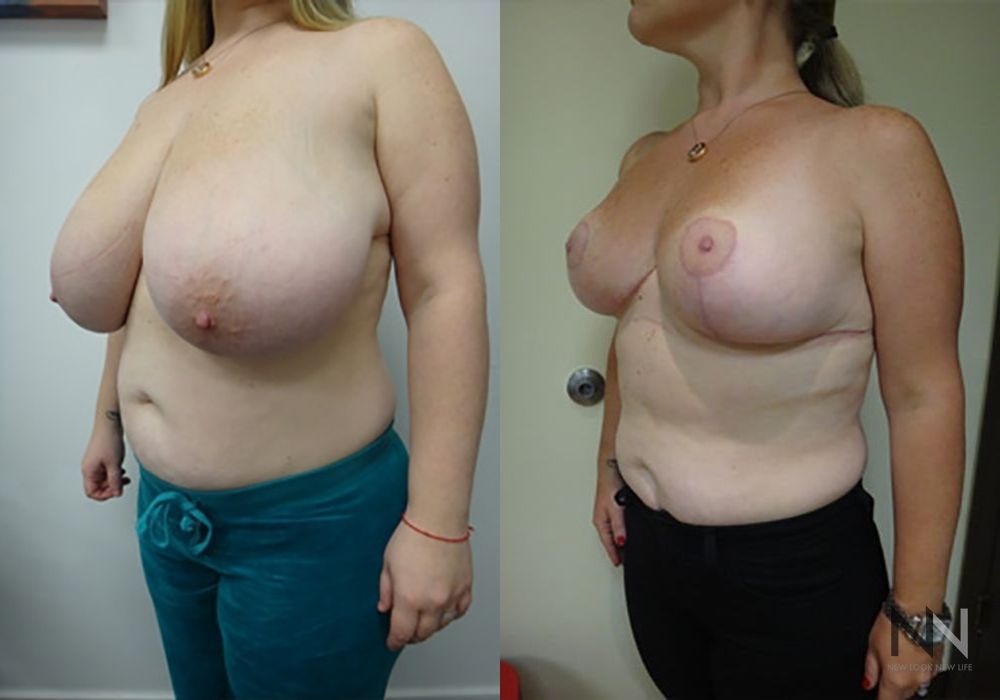 Breast Reduction - Thumbnail 2