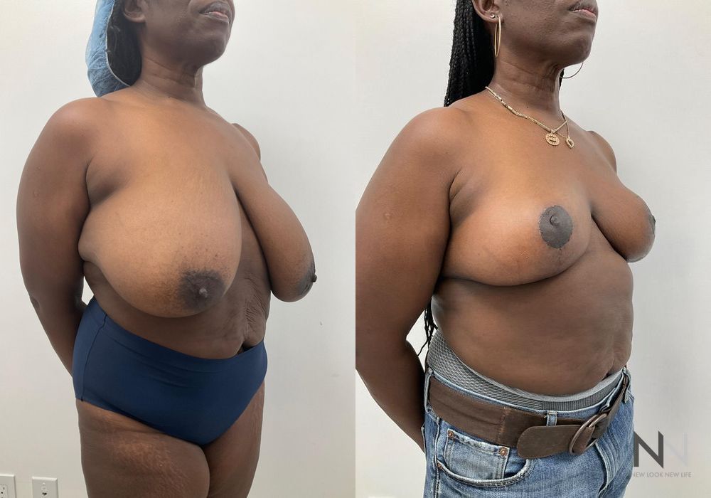 Breast Reduction - Case 1851