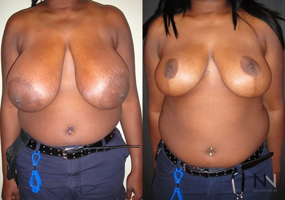 Breast Reduction - Case 2045