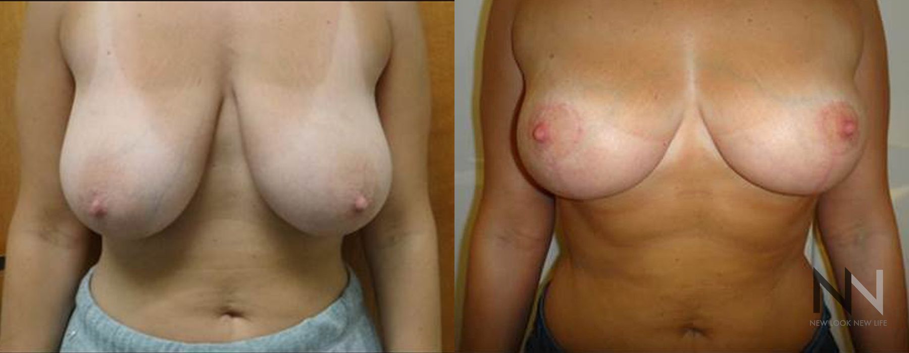 Breast Reduction - Thumbnail 3