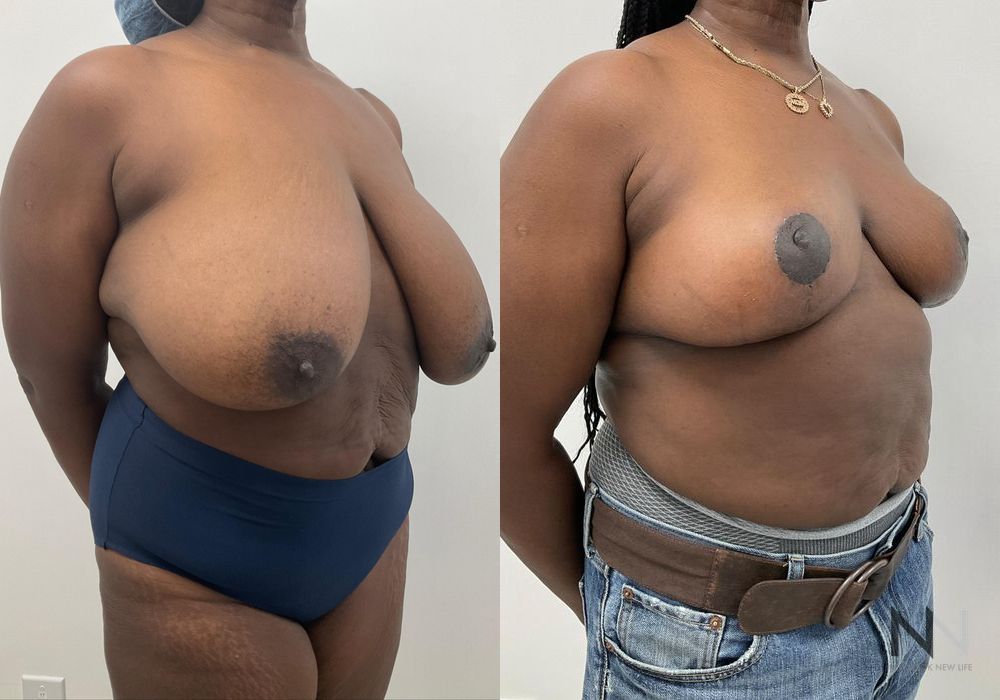 Breast Reduction - Thumbnail 2