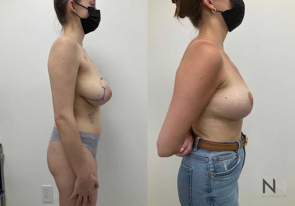 Breast Reduction - Case 1854