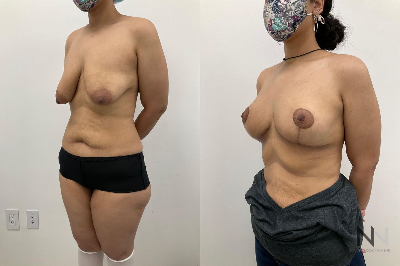 Before-and-after comparison showing improved breast balance, contour, and nipple position following right breast reduction and left breast mastopexy. - Angle 3
