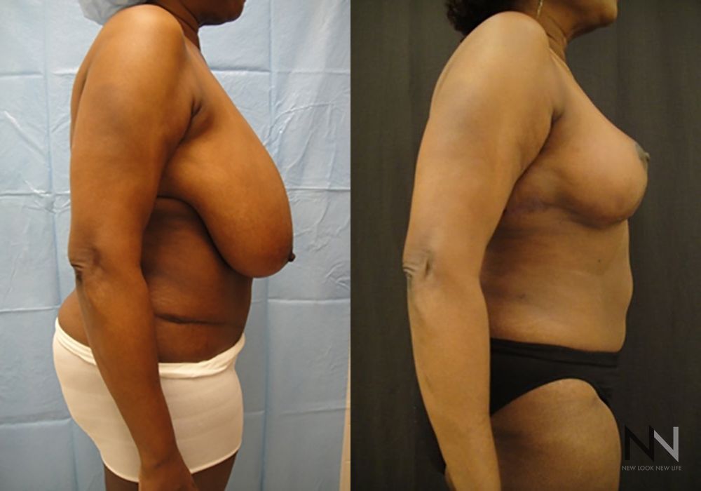 Breast Reduction - Thumbnail 5