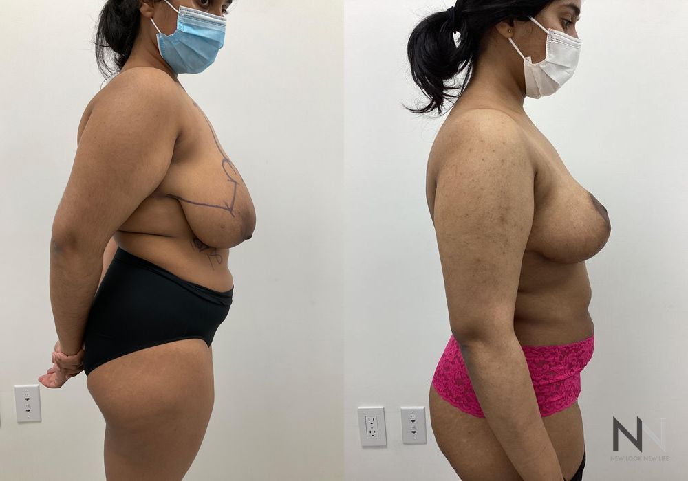 Breast Reduction - Thumbnail 3