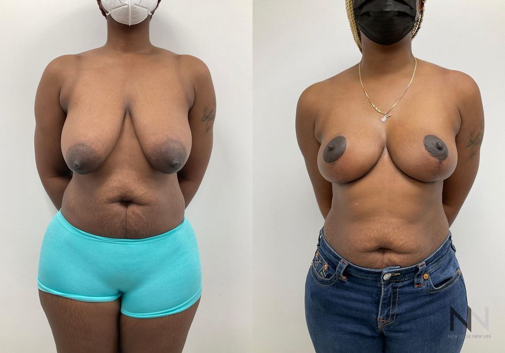 Breast Reduction - Case 2047