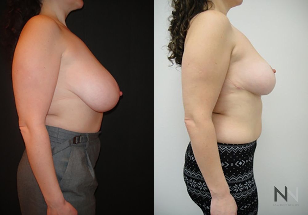 Breast Reduction - Thumbnail 5