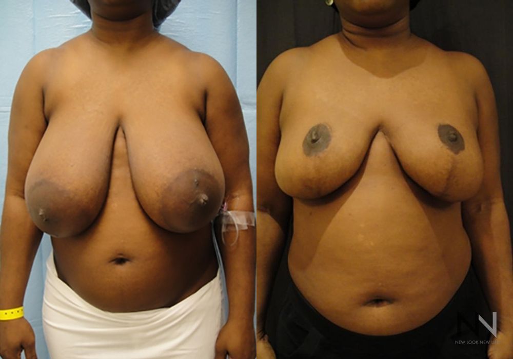 Breast Reduction - Case 2040