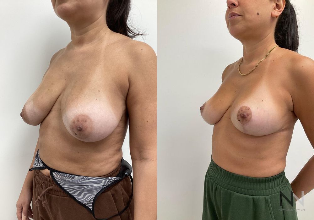 Breast Reduction - Thumbnail 2