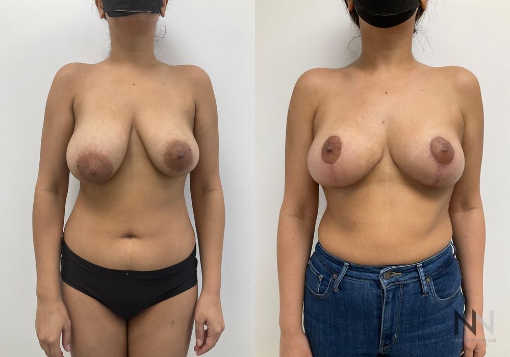 Breast Reduction - Case 1864