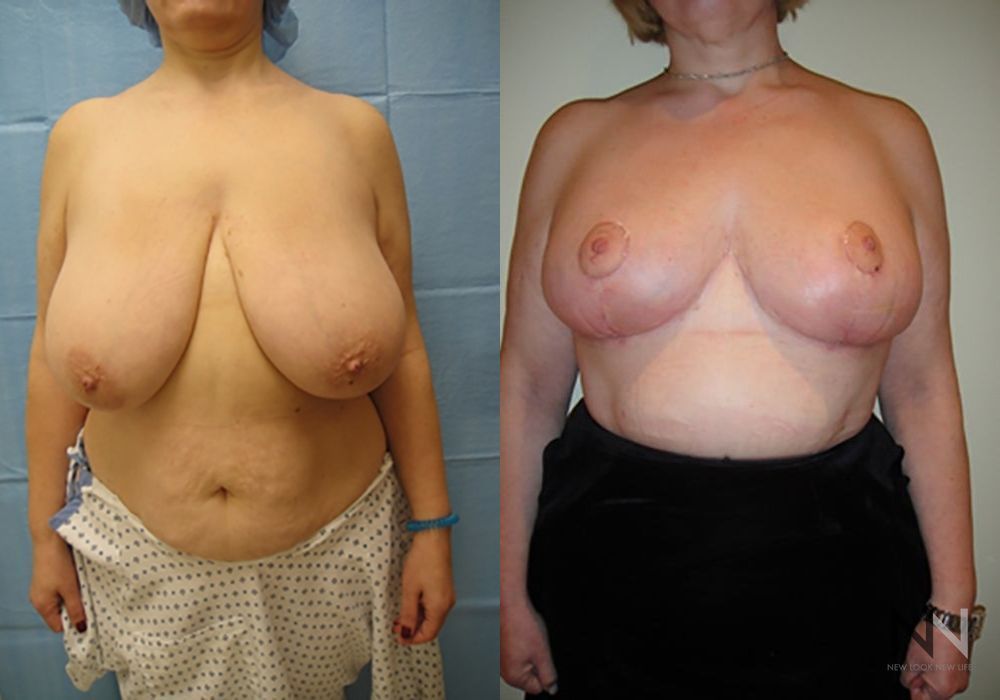 Breast Reduction - Thumbnail 3