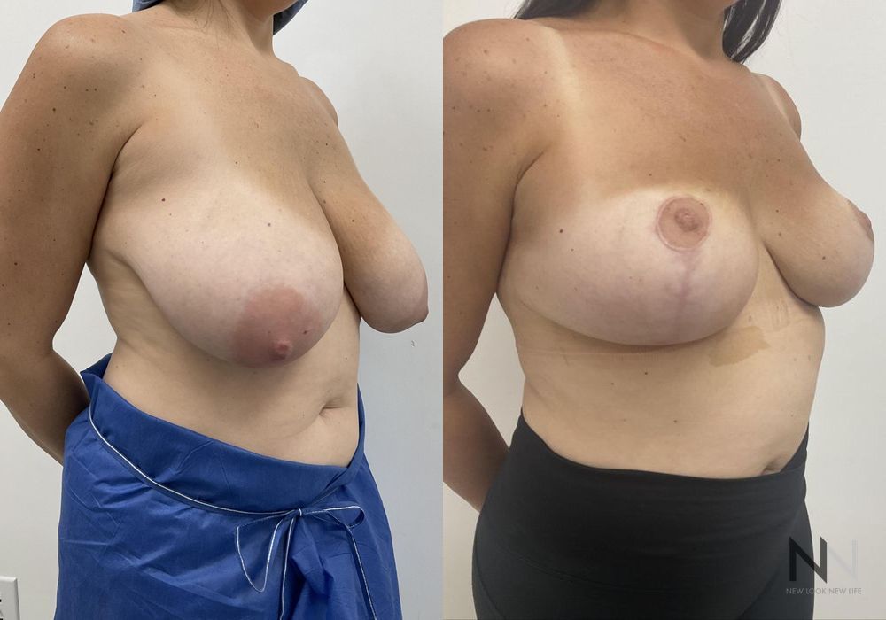 Breast Reduction - Thumbnail 2