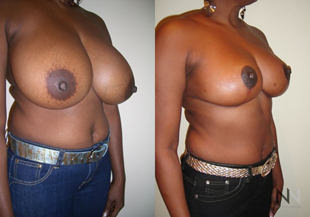 Breast Reduction - Thumbnail 4