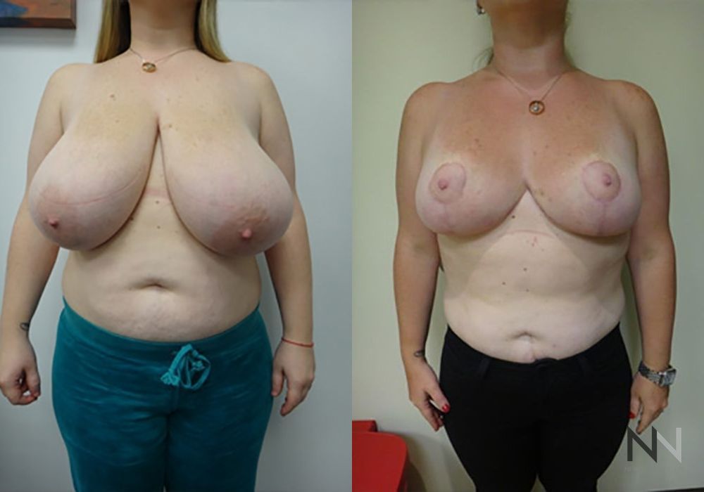 Breast Reduction - Case 2044