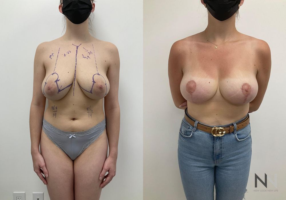 Breast Reduction - Thumbnail 2