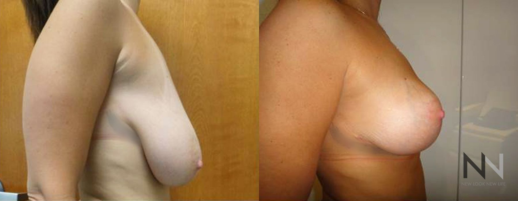 Breast Reduction - Case 1867