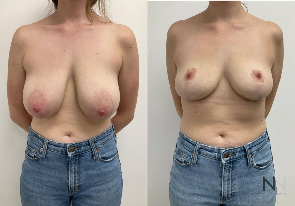 Before and after Breast Reduction case 21003