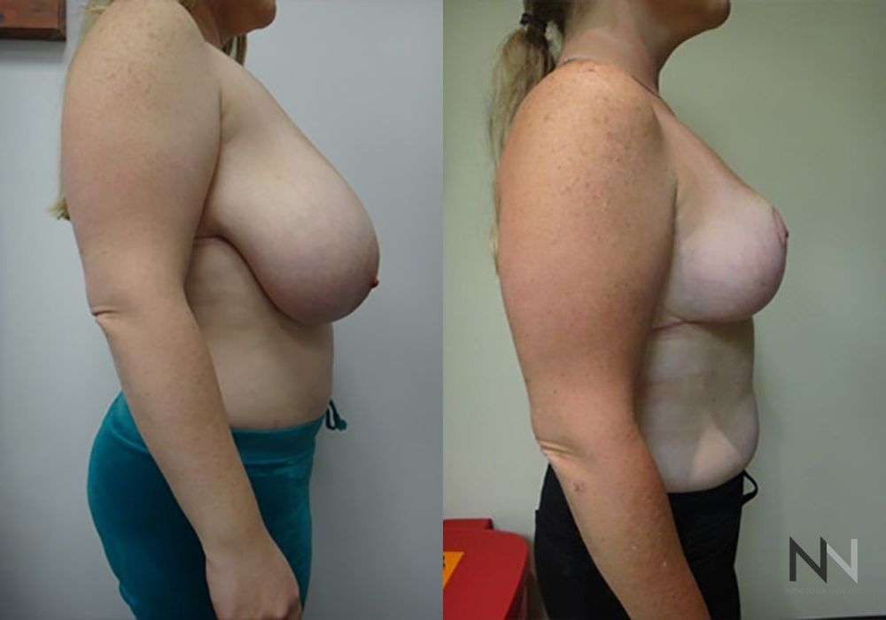Breast Reduction - Thumbnail 5