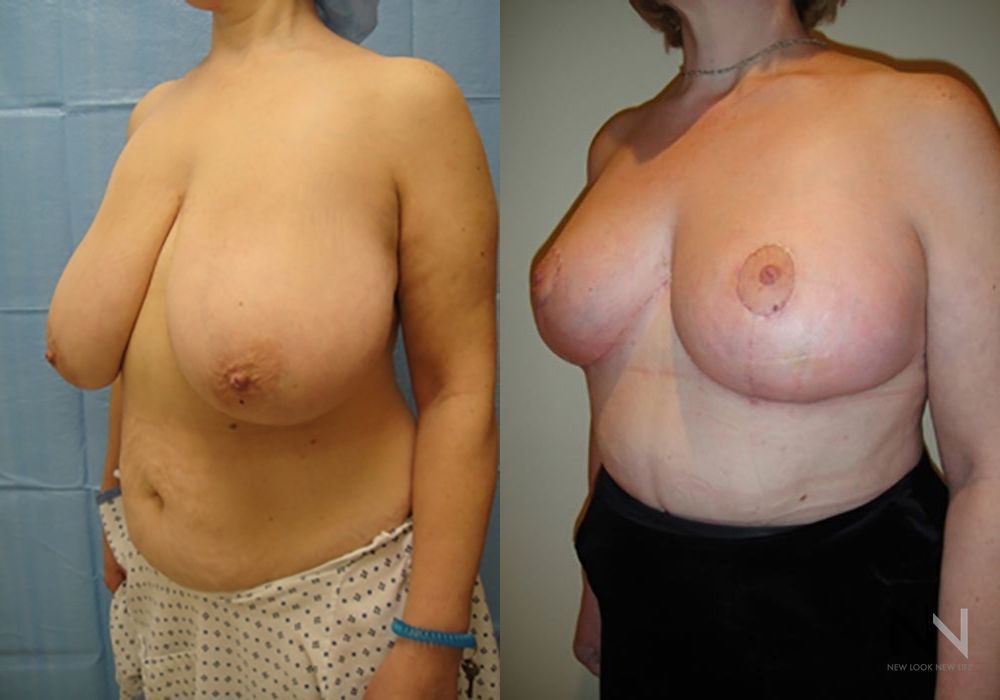 Breast Reduction - Thumbnail 5