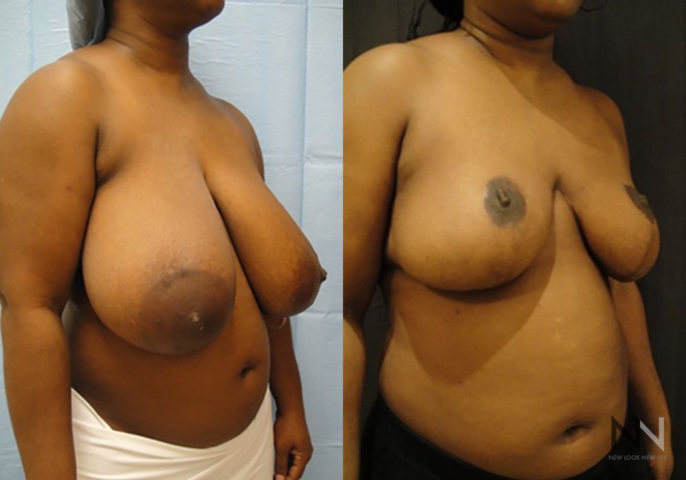 Breast Reduction - Thumbnail 4
