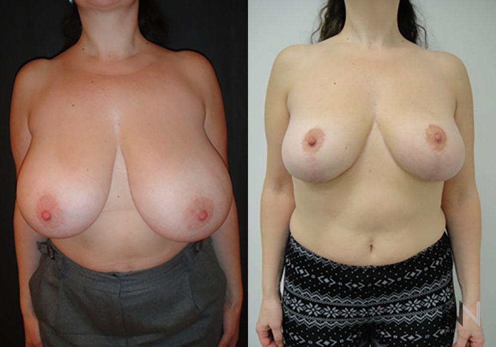 Breast Reduction - Case 2046