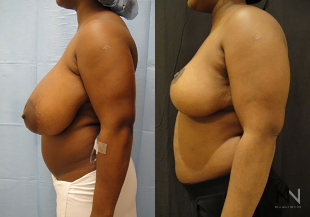 Breast Reduction - Thumbnail 3